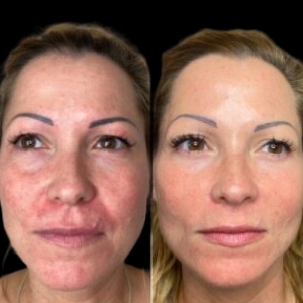 Why Profhilo Treatment in Dubai is a Must-Try for Anti-Aging