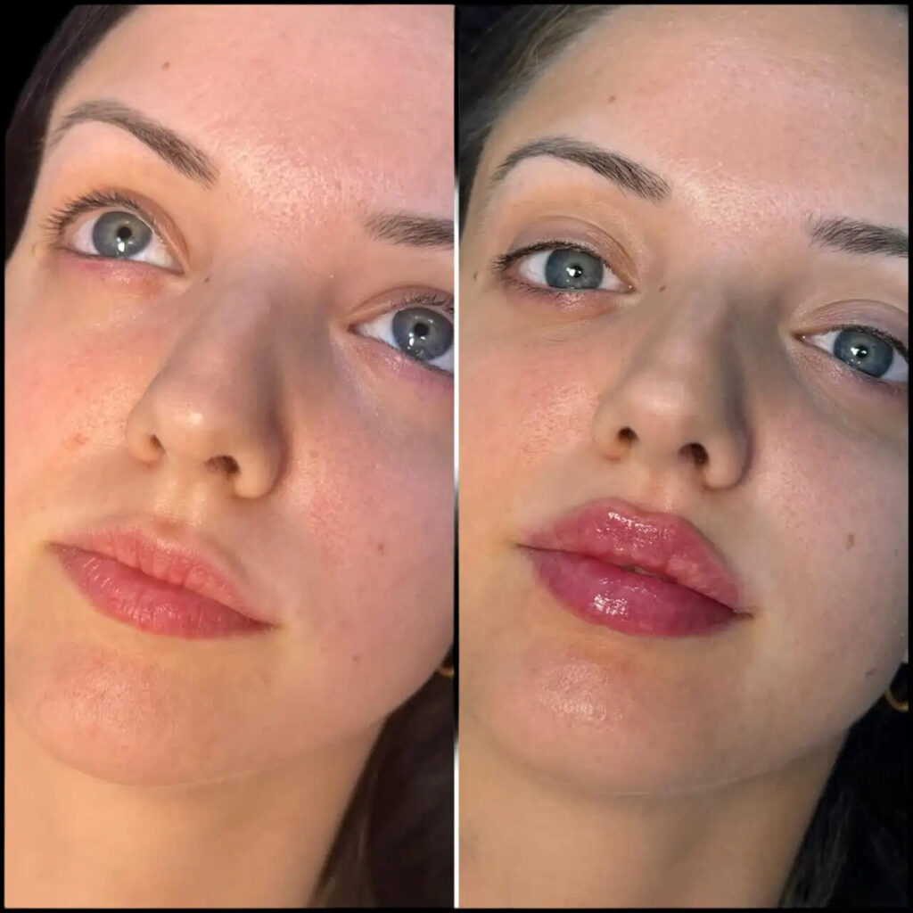 H5-lip-fillers (1)