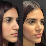 Where to Find the Best Rhinoplasty Surgeon in Dubai for a Perfect Nose Job