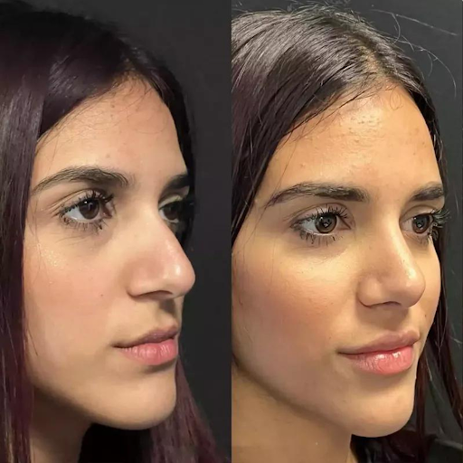 Where to Find the Best Rhinoplasty Surgeon in Dubai for a Perfect Nose Job