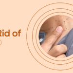 skin tags