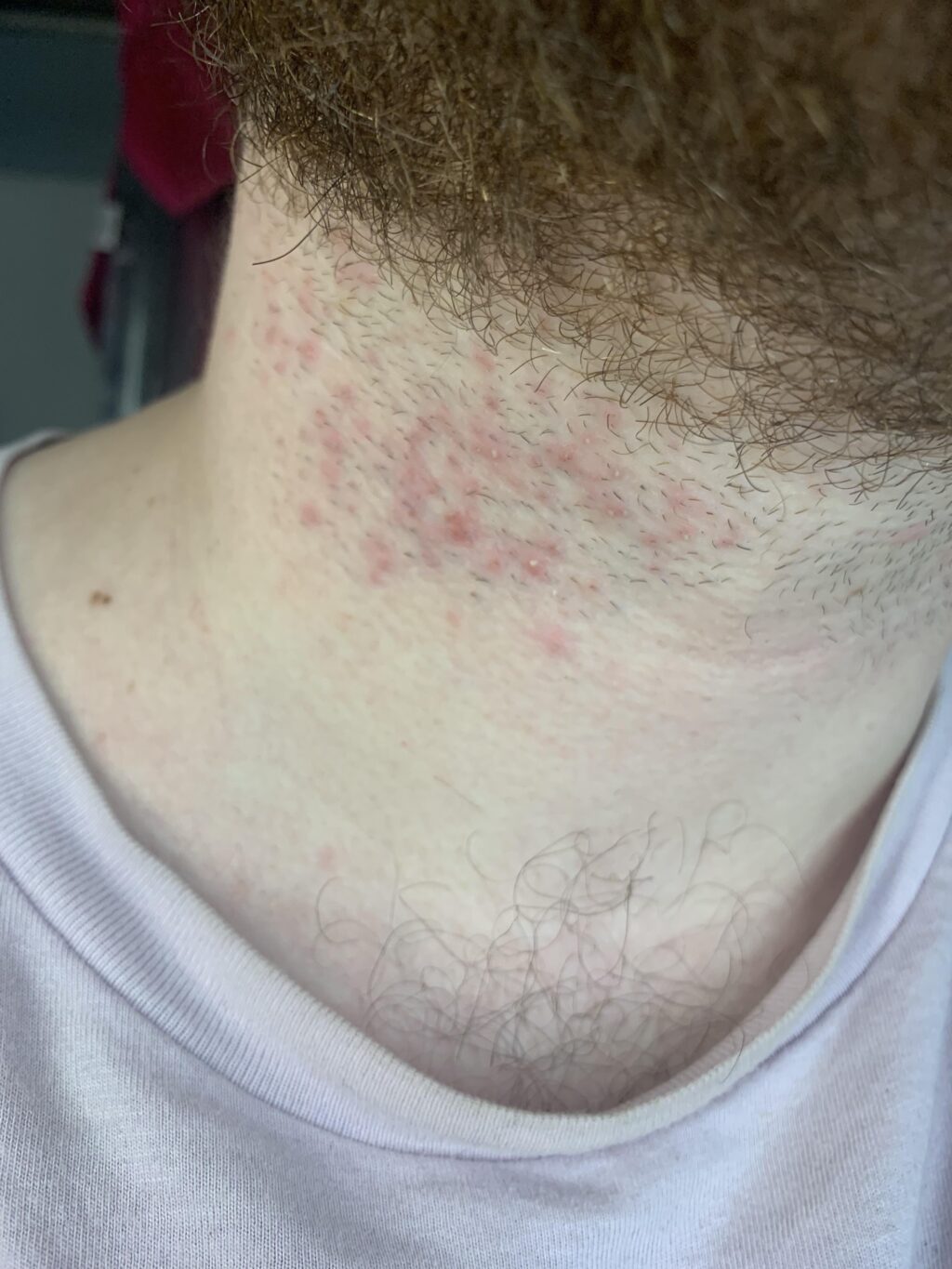 Razor Bumps