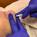 electrolysis