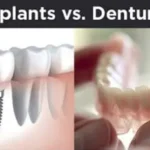 Dental Implants vs Dentures
