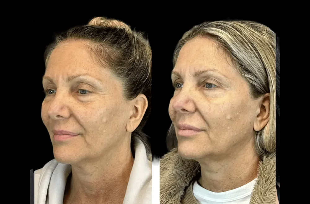 Botox in dubai