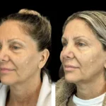 H9-Botox