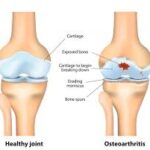 Gabapentin 300mg Joints from Osteoarthritis Pain