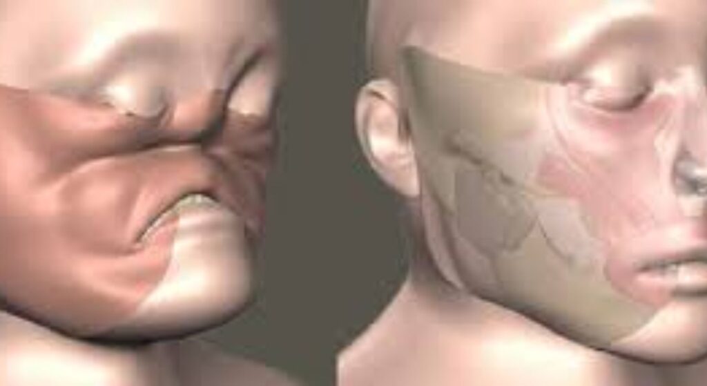 face transplant image