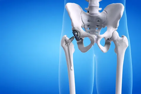 Total Hip Replacement in Islamabad