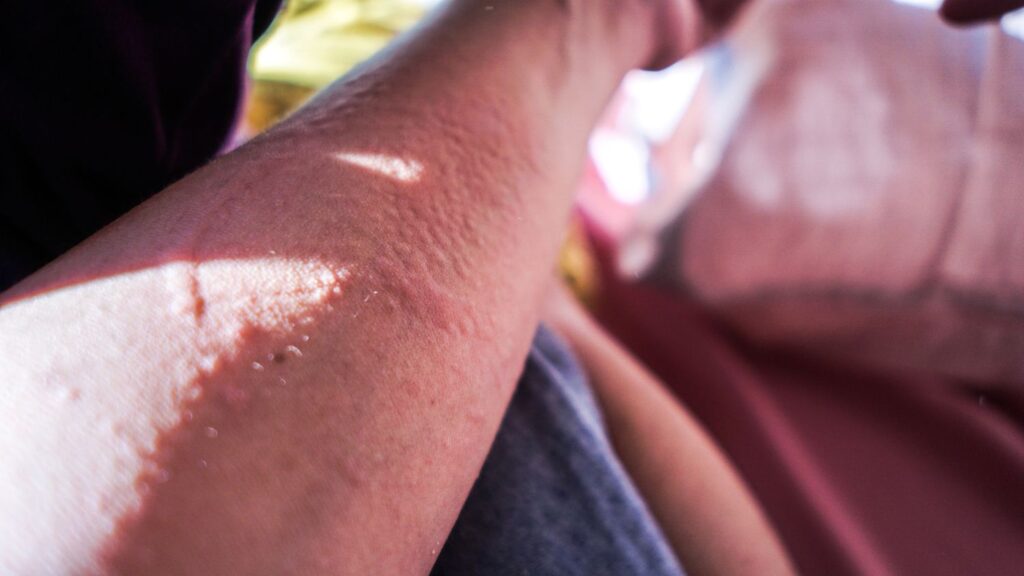 papules in eczema