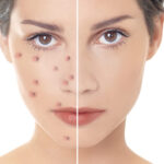 Pimples treatment in Islamabad