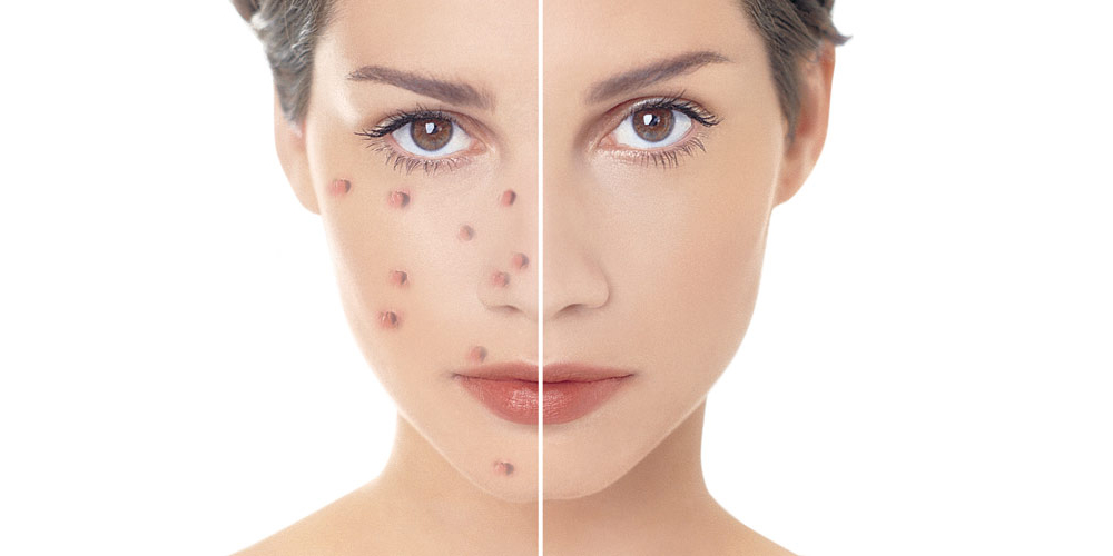 Pimples treatment in Islamabad