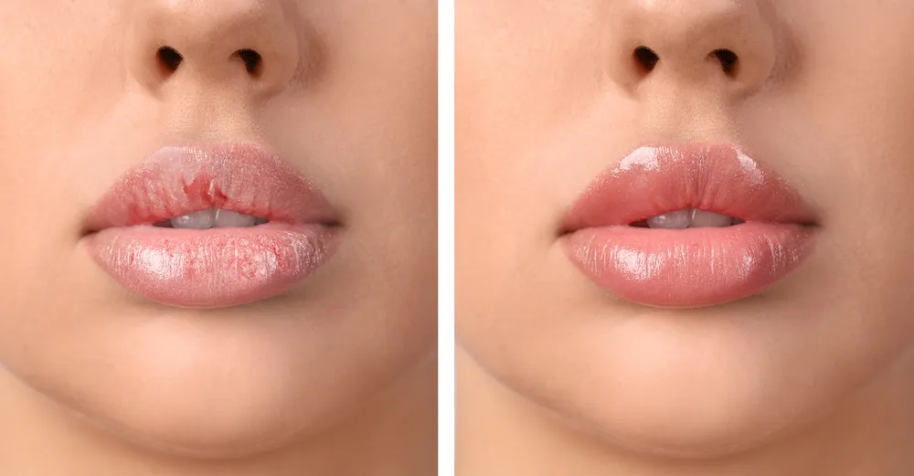 Lip Pigmentation Treatment: The Role of Sunscreen in Preventing Pigmentation Issues