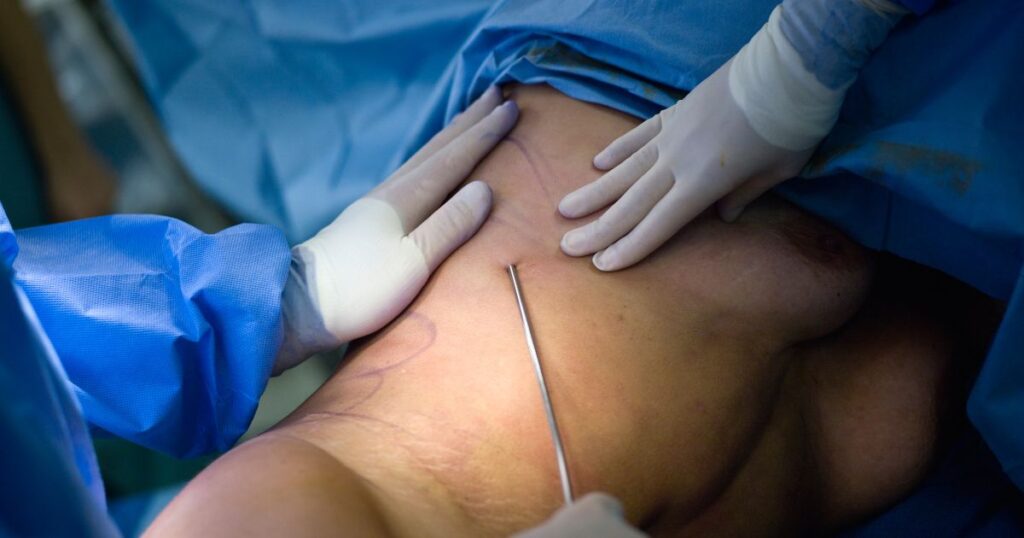 Laser liposuction in Dubai