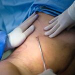 Laser liposuction in Dubai