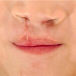 Cleft Lip Surgery Craniofacial Excellence in Abu Dhabi