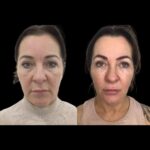Profhilo treatments in dubai