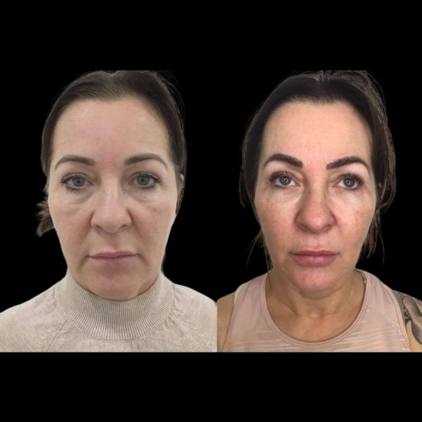 Profhilo treatments in dubai