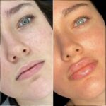 H1-lip-fillers (1)