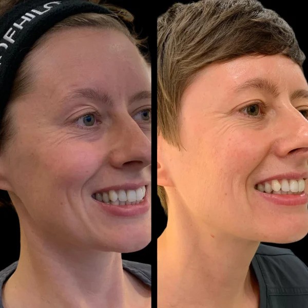 Profhilo in Dubai vs. Fillers Which Is Better for Your Skin