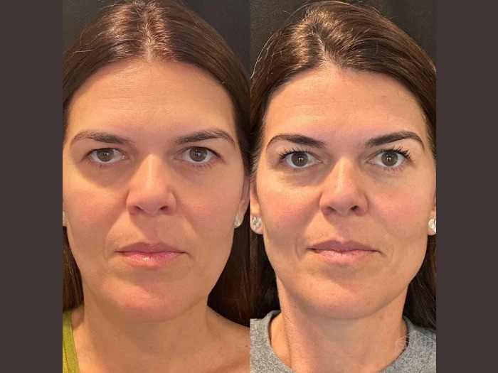 Thread Lift in Dubai for Jawline and Neck Rejuvenation