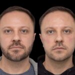 H6-Under-eye-fillers