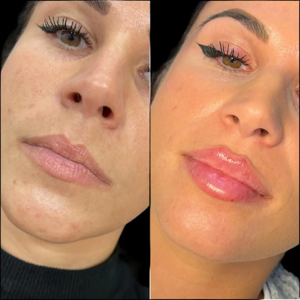 Fillers Doctors in dubai