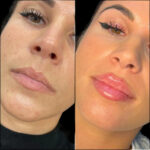Fillers Doctors in dubai