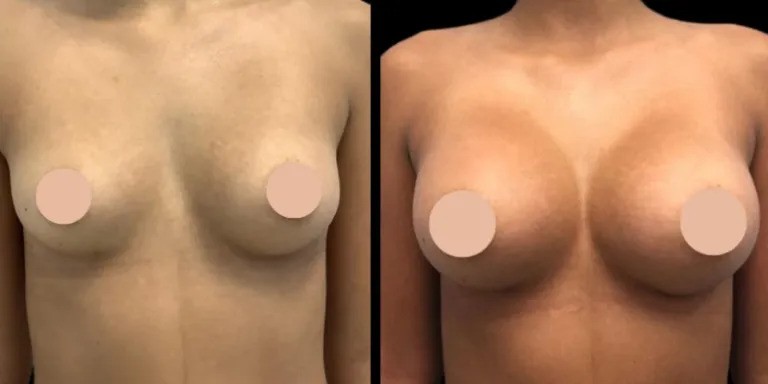 Best Breast Enhancement Surgeon in Dubai: What You Should Know About Implant Options