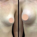 Best Breast Enhancement Surgeon in Dubai: What You Should Know About Implant Options