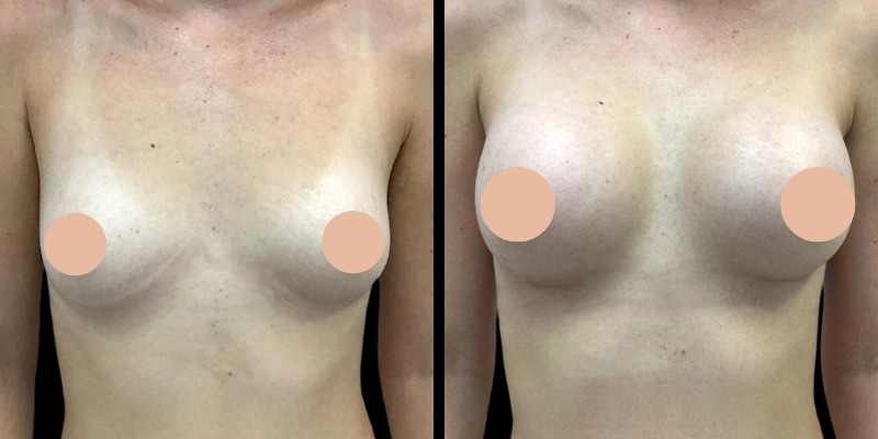 Best Breast Enlargement Surgeon in Dubai: How They Ensure Long-Lasting, Natural Results