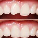 How Emergency Dentists Manage Broken and Knocked-Out Teeth