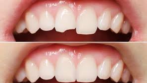 How Emergency Dentists Manage Broken and Knocked-Out Teeth