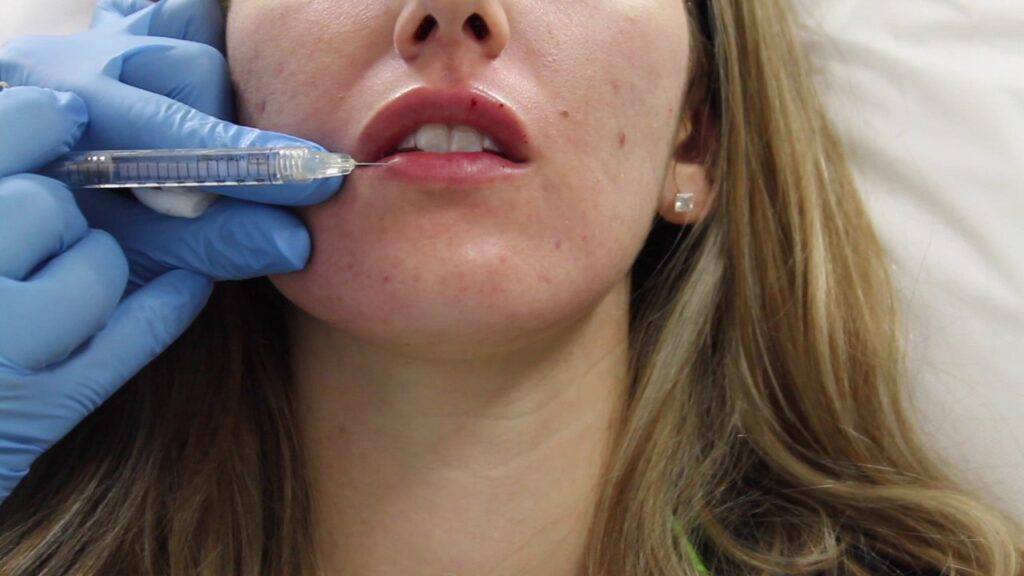 How Often Is Lip Fillers Injection Needed