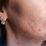 How Often Should You Get Acne Treatment?