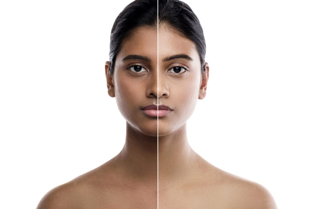 Is Whitening Treatment Effective on Dark Skin?