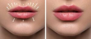 Lip Fillers