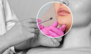 Lip Fillers