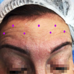 Mikrobaby-Botulinumtoxin
