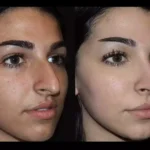 rhinoplasty in dubai