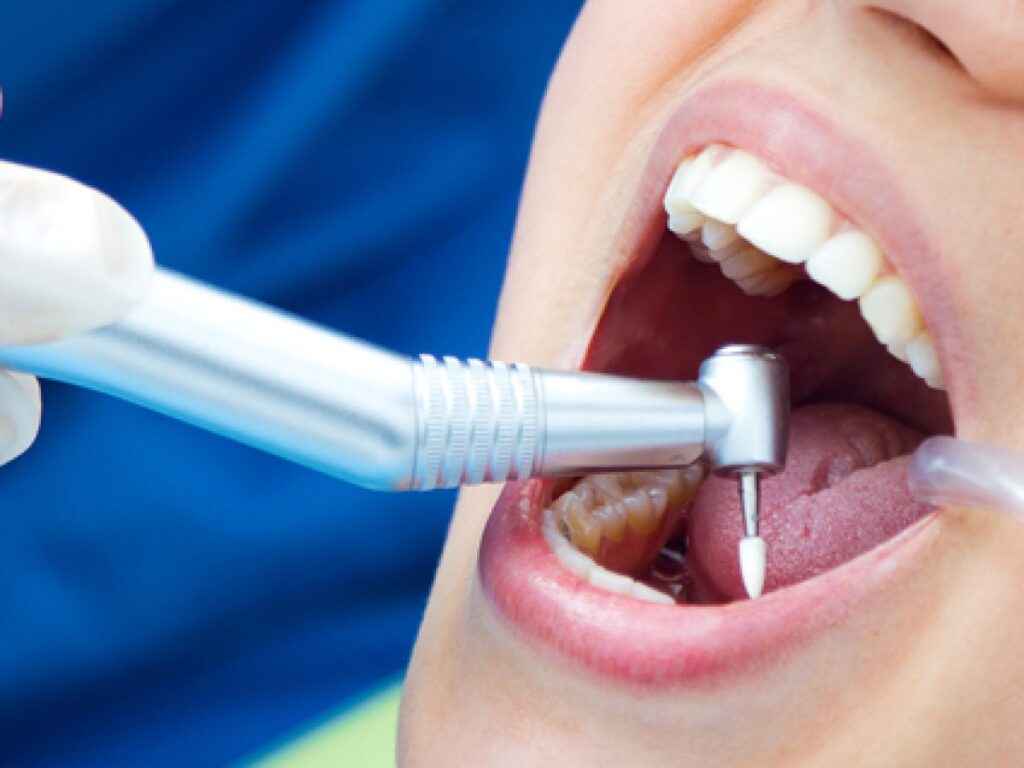 The Most Common Dental Procedures and What to Expect