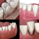 Types-of-Dental-Trauma