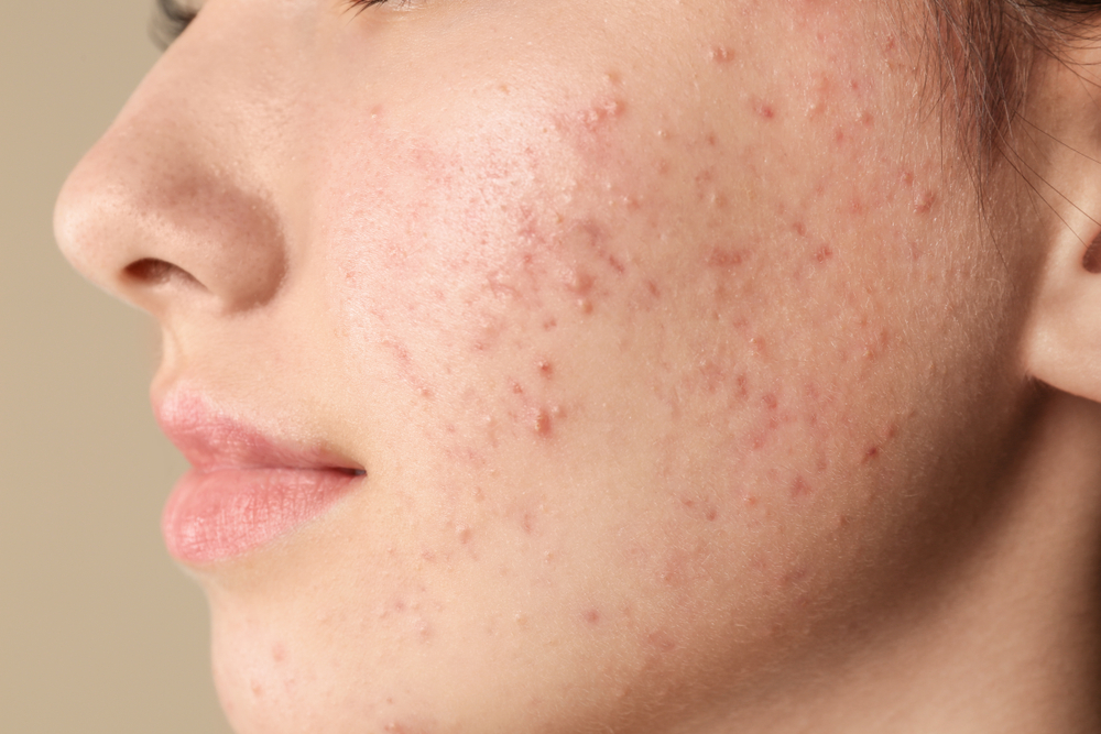 What Age Is Best for Acne Scar Treatment?