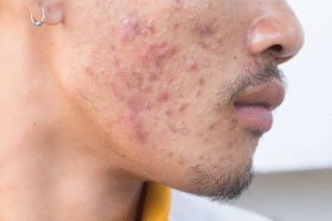 Acne Scar Treatment in Dubai