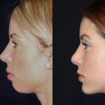 Chin Fillers in Dubai