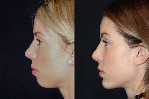 chin-implant-surgery-dubai