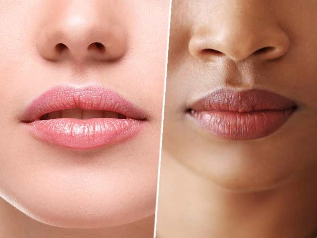 Lip Pigmentation Treatment