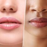 Lip Pigmentation Treatment
