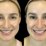 Botox in dubai