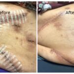 14_days_after_use_of_CRx_notice_surgical_wound_site_is_healing_and_lightening_the_the_scar_and_flattening_the_scar_too._Redness_has_decreased._Used_once_a_day_with_d (2)_3_11zon